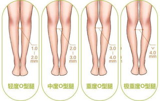 如何矫正O型腿的方法有哪些？ 2