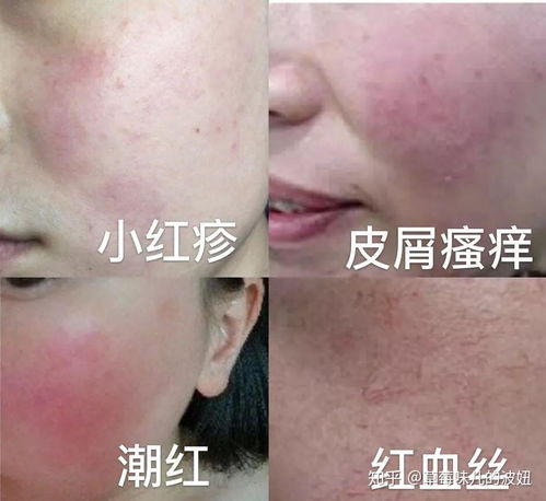 敏感肌如何修复变回正常皮肤？ 1