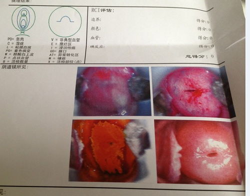 宫颈糜烂的有效治疗方法大揭秘 4