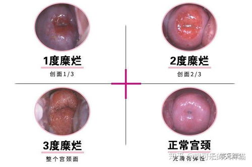 宫颈糜烂的有效治疗方法大揭秘 2