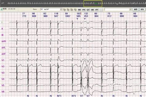 揭秘心电图：一读就懂的实用指南 1