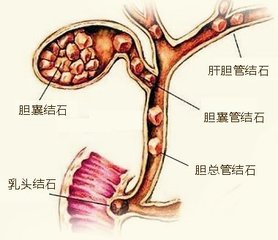 结石的成因探究 2