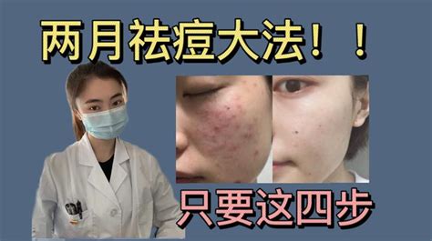 高效战痘攻略 1