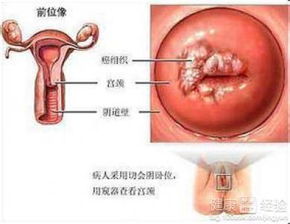 宫颈糜烂的有效治疗方法大揭秘 3