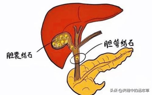 结石的成因探究 3