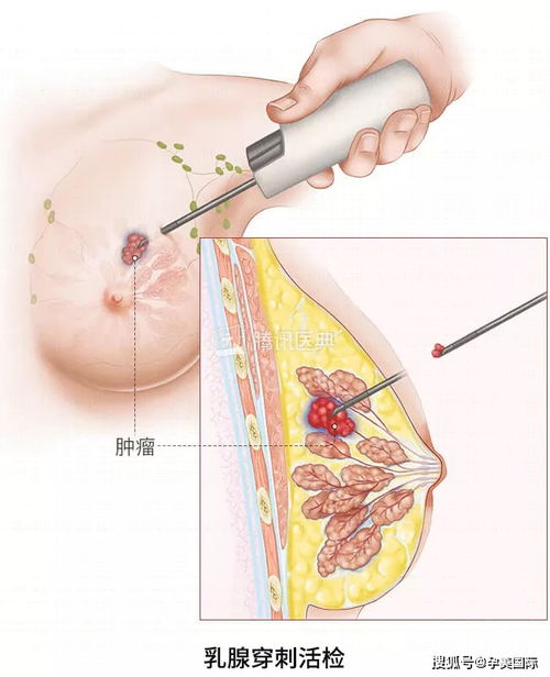 乳头出血应该怎么办？常见处理方法有哪些？ 3