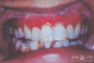 优化口腔扁平苔藓治疗方案 1