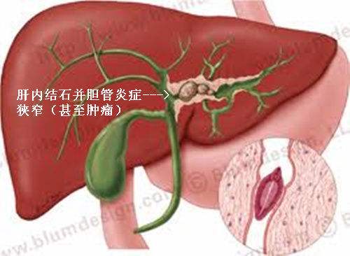 结石的成因探究 1